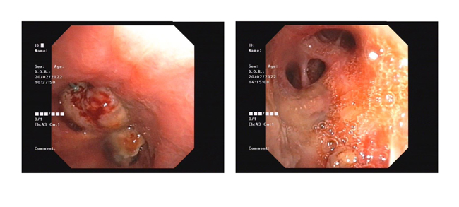 1646361140535977.jpg 支氣管鏡下消融術(shù)前后對比.jpg
