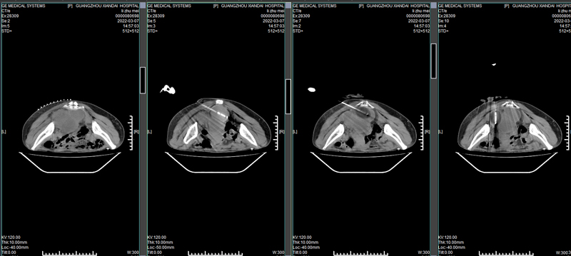 1646789216397141.jpg 術(shù)前術(shù)中CT對比02.jpg